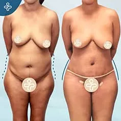 Before After