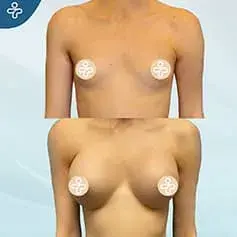 High+ Projection Implant Before & After