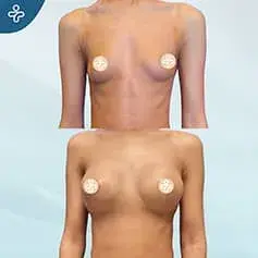 Moderate Projection Before and After