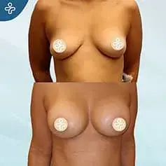 Contoured Implants B&A
