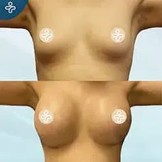 High+ Projection with Wide Base Before and After