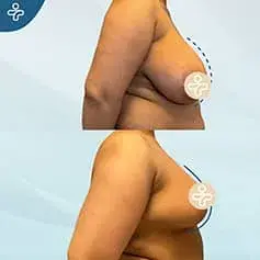 Inverted T Breast Reduction Before and After