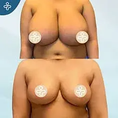 Inverted T Breast Reduction Before and After