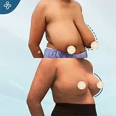 XXXL Extended Breast Reduction