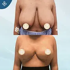 XXXL Extended Breast Reduction