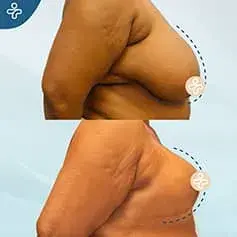 XL Reduction Before & After
