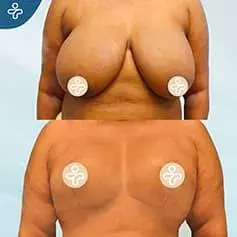 XL Reduction Before & After
