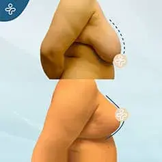 Breast Reduction + Uplift Before and After