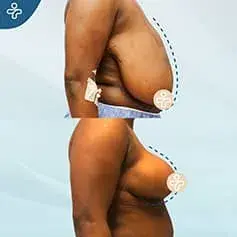 +XXXL Extended Breast Reduction