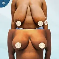 +XXXL Extended Breast Reduction