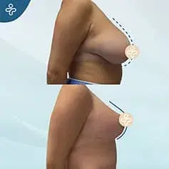 Anchor Breast Reduction Before and After