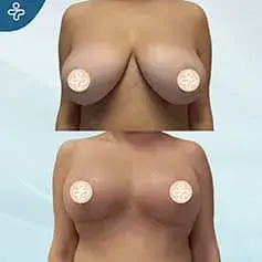 Anchor Breast Reduction Before and After