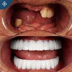 Antes Después Odontología