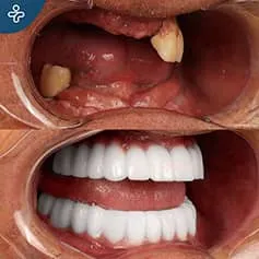 Antes Después Odontología
