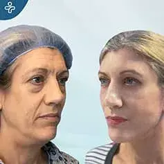 Extended High SMAS Facelift Before and After
