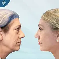 Extended High SMAS Facelift Before and After