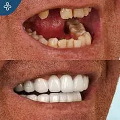 Single Tooth Implant and Crowns Before & After