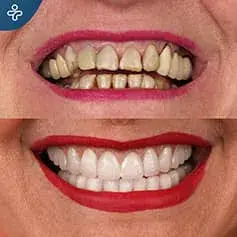 Full Smile Makeover Before&After
