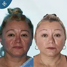 Full Neck Lift Before & After