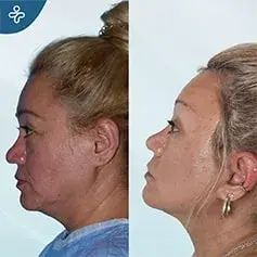 Temporal Lift 3 Months Before and After