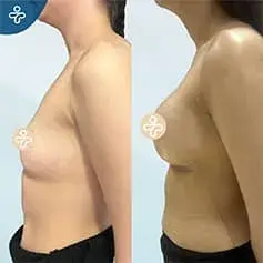 Impianti Anatomici ad Alta Proiezione Prima Dopo