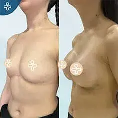 Impianti Anatomici ad Alta Proiezione Prima Dopo