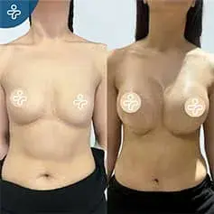 Impianti Anatomici ad Alta Proiezione Prima Dopo