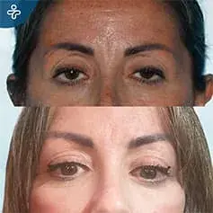 Mini Brow Lift Before and After