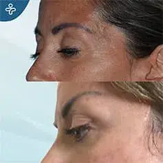 Eyelid Rejuvenation with Fat Injection Before and After