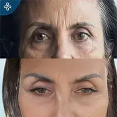 Double Eyelid Surgery Before and After