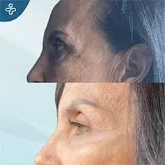 Double Eyelid Surgery Before and After