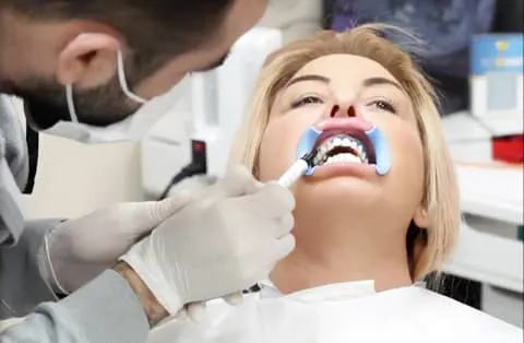 Sbiancamento Dentale