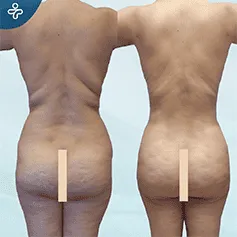 tummy-tuck-revision-3